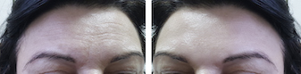 Before and After Injection photo, showing significant smoothing of fine lines