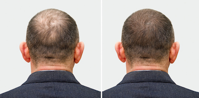 Before and after photos of hair loss treatment showing significant growth